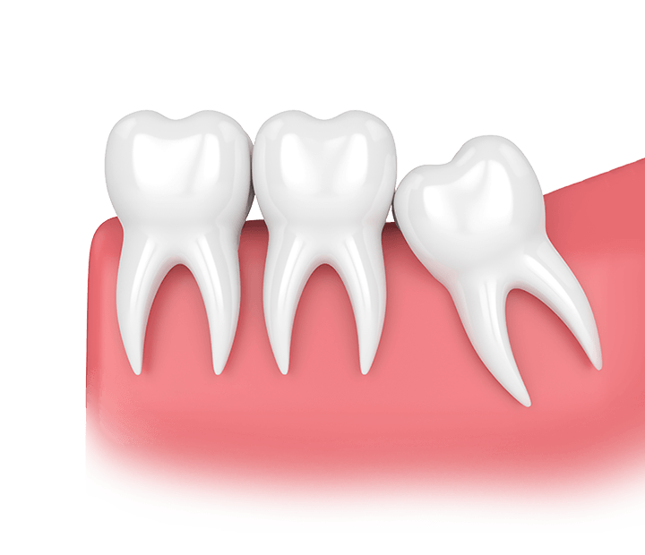 Photo of a incorrect growth of a wisdom tooth